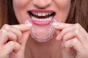 clear braces aligners